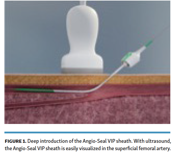 UltrasoundAssisted AngioSeal VIP Closure of Antegrade Femoral Access